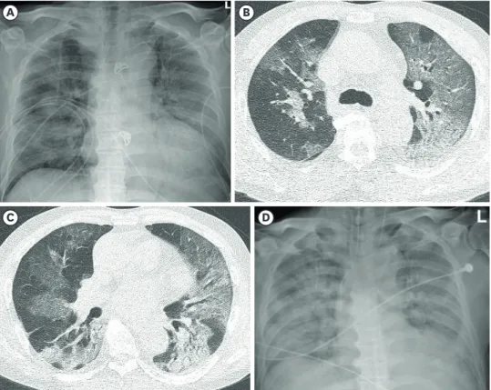 Fig. 2. Coronavirus disease 2019 pneumonia with a diffuse alveolar damage pattern in a 72-year-old man