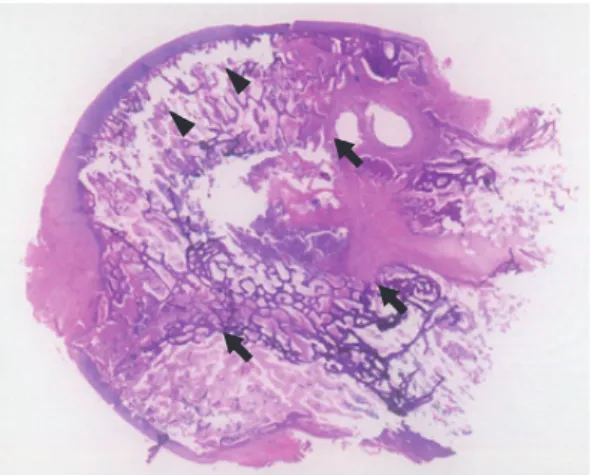 Fig. 5. Fibrous encapsulation (arrows) is seen at the peripheral portion of the sequestrum (Arlet and Durroux  Type 4 lesion)