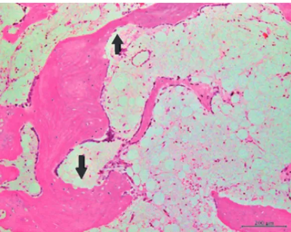 Fig. 6. Bone trabeculae are thin and lined by osteoblasts. Focal bone resorption is seen at some areas (arrows)