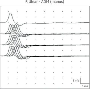 Fig. 1. Electromyography, low frequency (2, 3, and 5 Hz) repetitive nerve stimulation