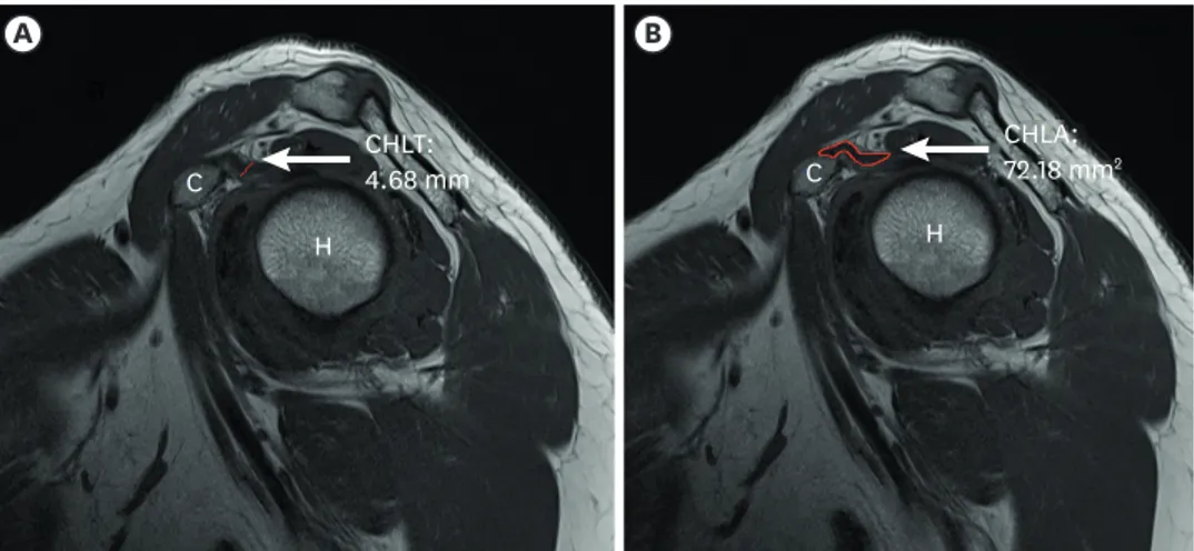 Fig. 1. T2-weighted TSE oblique sagittal shoulder magnetic resonance images: (A) CHLT in the FS, (B) CHLA in the FS