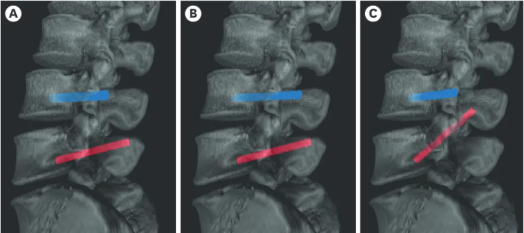 Fig. 5. Comparison of screw models on 3D view with pedicle-screw correction in the simulator
