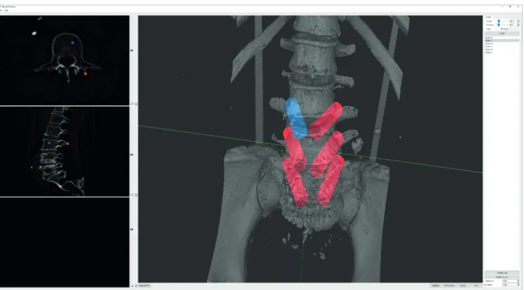 Fig. 7. A screenshot of screw-fixation planning on the multiplanar reconstruction section view.