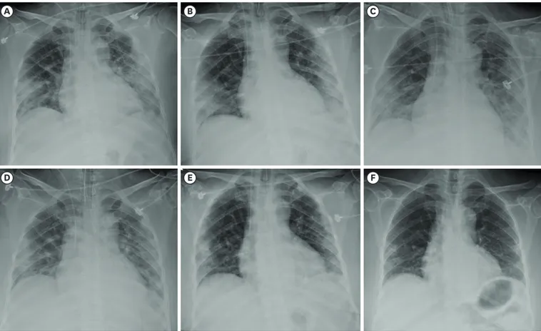 Fig. 1. Chest radiographs on (A) Day 1, (B) Day 2, (C) Day 3, (D) Day 5, (E) Day 8, and (F) Day 22 of hospitalization.