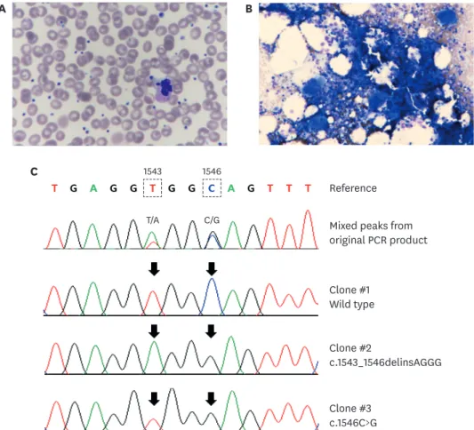 Fig. 1. Hematological and molecular characteristics of an essential thrombocythemia patient with coexisting JAK2 and MPL driver mutations