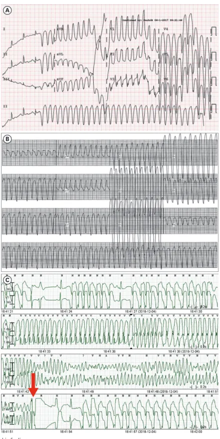 Fig. 2. VT and VF electrocardiographic findings. 
