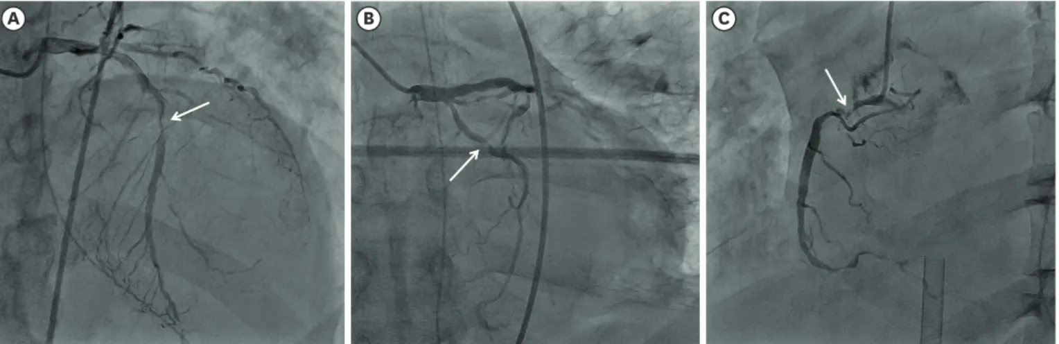 Fig. 5. Final coronary angiogram after percutaneous coronary intervention. (A) Drug eluting stents were implanted in mid portion of left descending coronary  artery and (C) proximal portion of right coronary artery