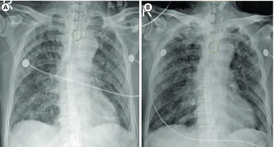 Fig. 1. Before surgery, chest radiography was used to adjust the position of the place where the balloon was  supposed to be between the level of the second tracheal ring and the carina