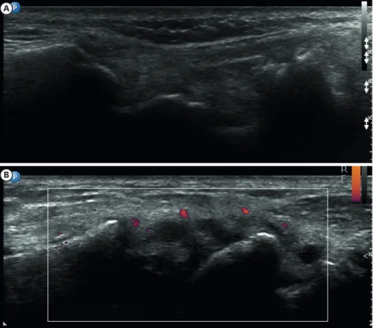 Fig. 1. Definition of imaging remission (right wrist). (A) Absence of PD, (B) presence of PD