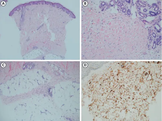 Fig. 3. Pathologic findings of the skin biopsy. (A) Thickened dermis with collagen deposits (H &amp; E stain, × 40)