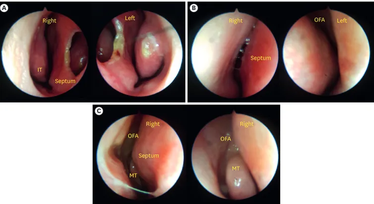 Fig. 1. Smart portable nasal endoscopic system findings. (A) Large septal perforation prior to septal cartilage harvest for rhinoplasty