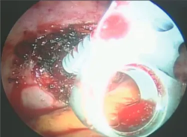FIGURE 3. This picture shows the partial corpectomy site of 
