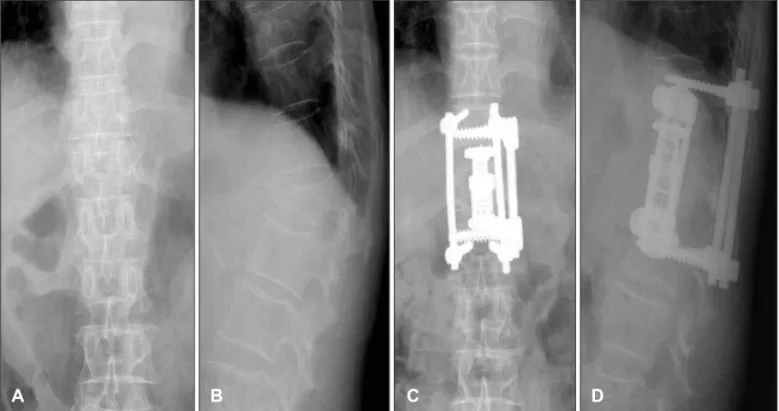 FIGURE 5. Postoperatively anteroposterior (A) and lateral (B) plain films show T12 burst fracture and postoperatively anteroposte- anteroposte-rior (C) and lateral (D) plain films show partial corpectomy and circumferential fixation at thoracolumbar verteb