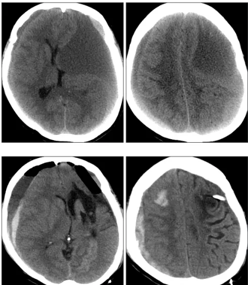FIGURE 2. Postoperative computerized tomog- tomog-raphy (CT) scans just after surgery reveal acute  brain shift from right to left side contrary to initial  CT scans and acute subdural and intracerebral  hemorrhage on the “contralateral” side of the  huge 