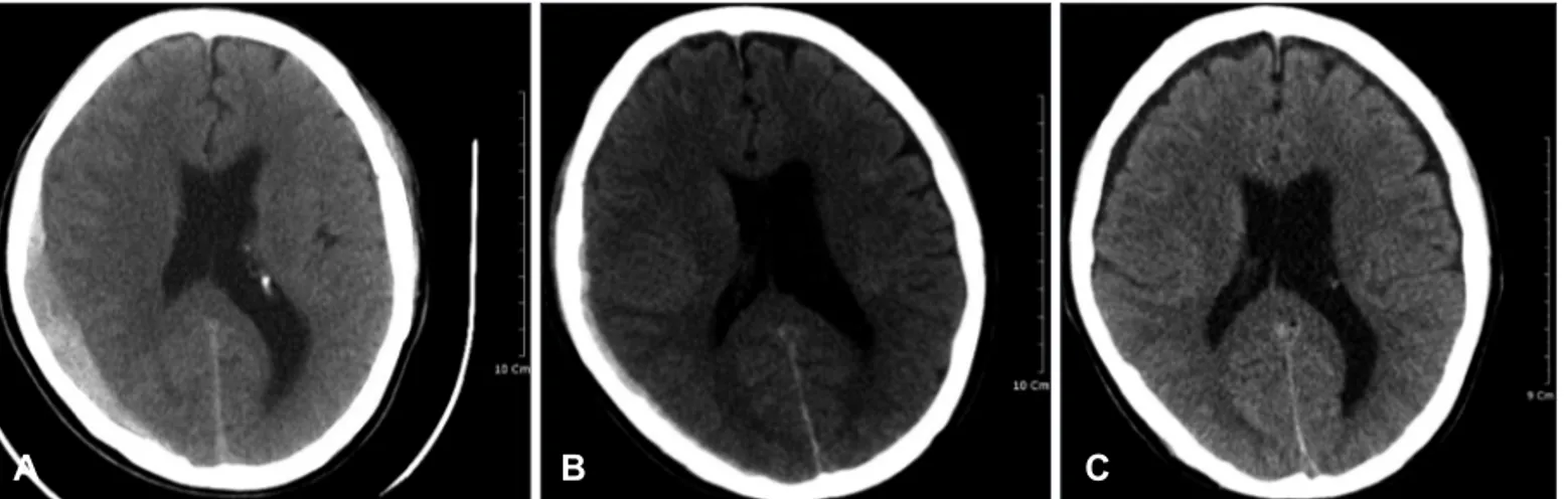 FIGURE 2. Brain CT images of  case 2. A: Initial brain CT scan  revealed an acute SDH with a  maximal thickness of  approxi-mately 17 mm in the right  con-vexity and a midline shift of 18  mm