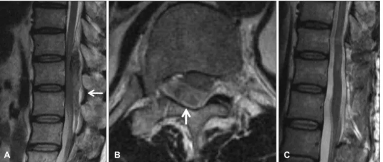 FIGURE 1. Preoperative and Postoperative MRI of 61 year-old male patient (case 7). He visited to emergency room with lower ex- ex-tremities weakness and voiding difficulty after ESWL treatment for urolithiasis