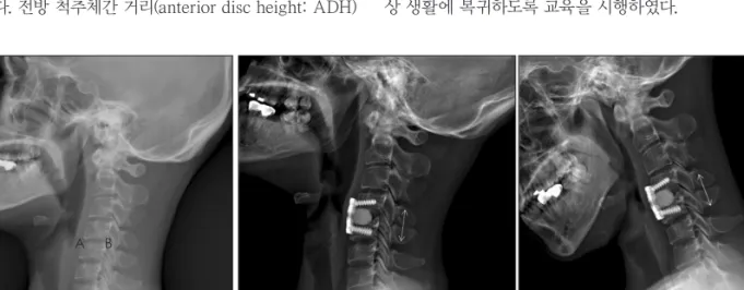 FIGURE 1. A: Mean height=(A+B)/2, A=anterior disc height, B=posterior disc height. B: C spine Stress view.