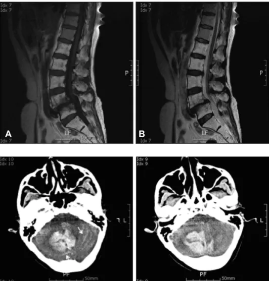 FIGURE 2. Axial CT scan obtained 45  hours after lumbar surgery, reveals large  intracerebellar hemorrhage (central to  right) with a streaky, curvilinear  bleed-ing pattern in the cerebellar sulci (arrow).