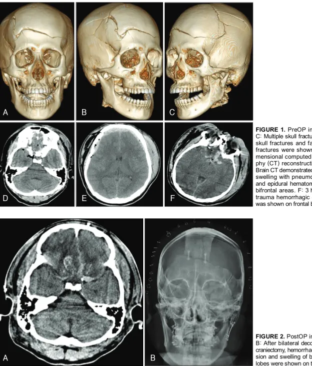 FIGURE 1. PreOP images. A- A-C: Multiple skull fractures, basal  skull fractures and facial bone  fractures were shown on  3-di-mensional computed  tomogra-phy (CT) reconstruction