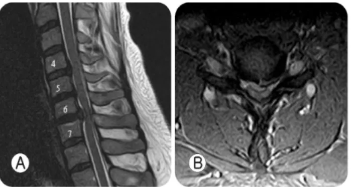 Fig. 2. A: Postoperative sagittal T2-weighted MR imaging  showing  high  signal  intensity  of  spinal  cord  at  C6-7