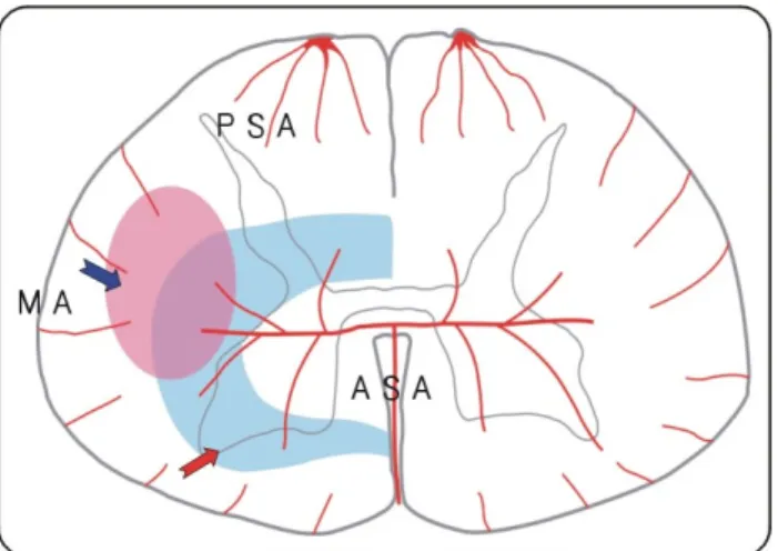 Fig.  3.  Blood  supply  of  cervical  spinal  cord,  PSA:  pos-  terior spinal artery, ASA: anterior spinal artery, MA:  margi-nal  artery,  lateral  corticospimargi-nal  tract (blue  arrow),  water-  shed  area  of  vascular  territory (red  arrow).