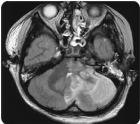 Fig.  2.  T2-weighted  image  MRI  axial  scan  shows  acute  infarction in cerebellum and high signal intensity lesion in  brain  stem.그러므로 저자들은 조기에 뇌자기공명영상촬영을 통하여 뇌신경과  속목동맥손상을  진단하고,  치료하였던  두  증례를 소개하고,  두개저부골절에서의 뇌자기공명영상의 진단적 가치에 대하여 기술하고자 한다