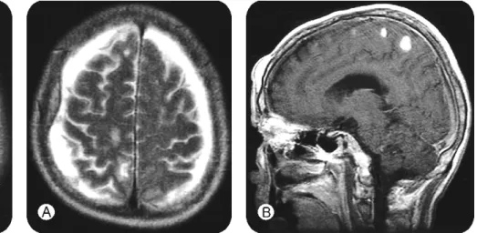 Fig.  1-C.  Coronal  and  Sagittal  T2WI  showing  a  hemorrhagic  contusion  in  left premotor area (containing SMA) as hypointense  center  with  hyperintense  in  the  periphery.