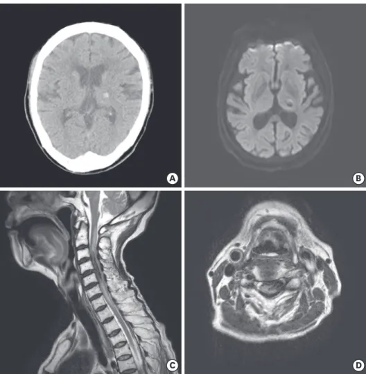 FIGURE 1. (A) Noncontrast brain computed tomography showed acute intracerebral hemorrhage in the left side  thalamus