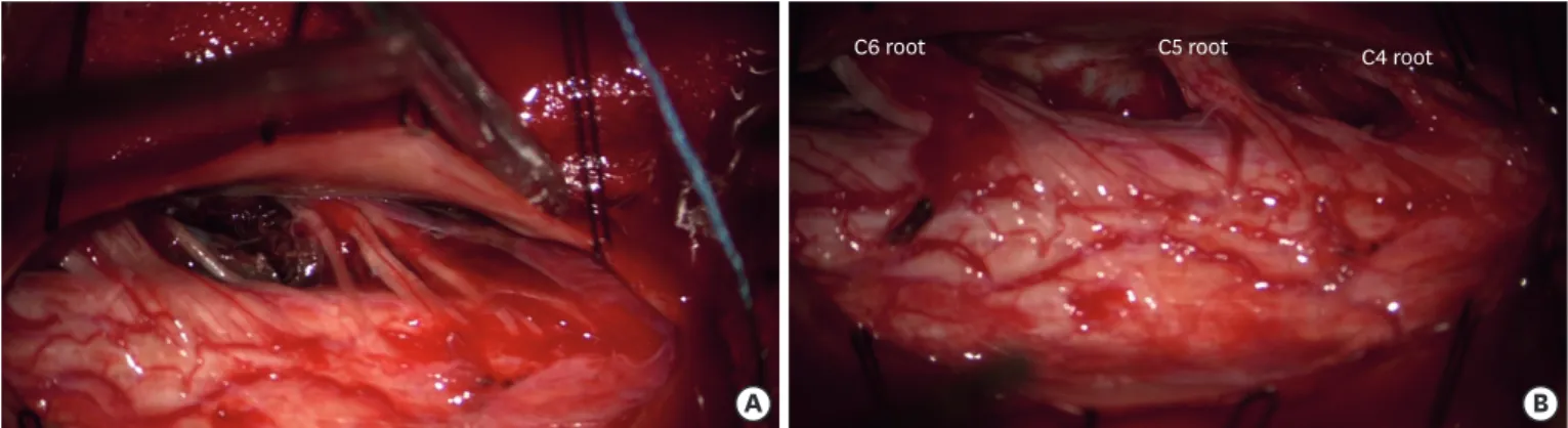 FIGURE 2. (A) Intraoperative photographic images under a microscope: after total laminectomy on C3-6, the dura and arachnoid membrane was longitudinally  opened, which showed small CSF-mixed hematoma in subdural space and a dark blood color of hematoma in 