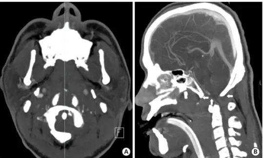 FIGURE 2. Three dimensional computed tomography angiography of axial (C1) and midsagittal reconstruction view show atlanto-occipital dislocation and  associated lesion of medulla oblongata and upper cervical cord