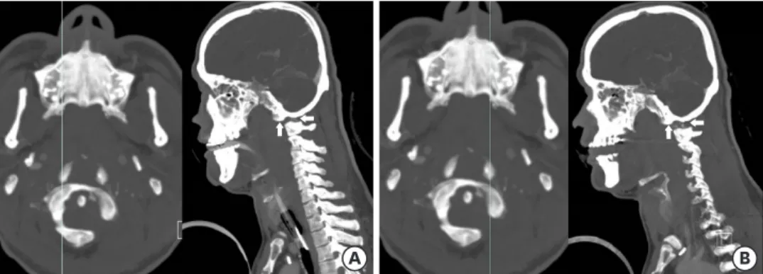 FIGURE 3. Sagittally reformatted computed tomography images show dislocation of the right (A) and left (B)  atlanto-occipital joints.