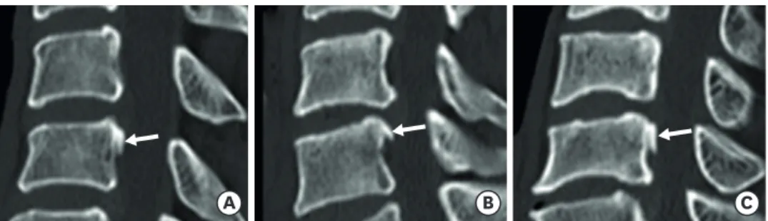 FIGURE 2. Sagittal plane of preoperative cervical spine CT scan: Three patients had the cervical disc herniation  and minimal segmental-type OPLL (arrow) (A-C)