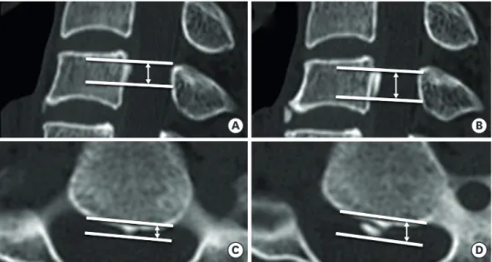 FIGURE 3. Immediate postoperative sagittal and axial computed tomography images of a 39-year-old male  underwent a total disc replacement at C5-C6 illustrating the method of measuring the size of OPLL mass  longitudinally (A) and horizontally (B)