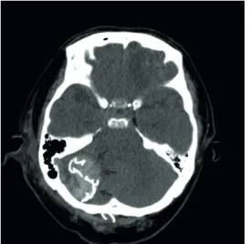 FIGURE 3. The postoperative brain computerized tomography exhibits the hyperdense gauze shadow with  radiopaque markers (arrows), but no significant intraparenchymal haemorrhage, ischemic lesion, or mass effect  against brain stem.