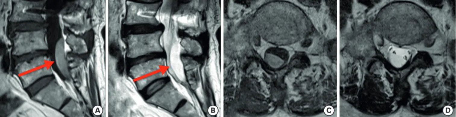 FIGURE 1. Lumbar spine MRI images of the patient. Sagittal T1-weighted (A) and T2-weighted (B) images reveal a hematoma (arrows) in the dorsal spine at the  L4–S1 level