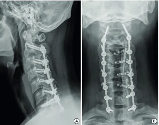 FIGURE 3. A recent plain radiograph of the cervical spine: lateral view (A), anteroposterior view (B).