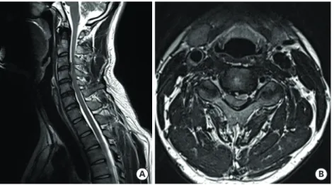 FIGURE 1. Preoperative cervical MRI. Sagittal (A) MRI shows a herniated disc at the C3–4 level
