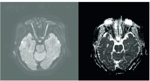 FIGURE 3. Orbit magnetic resonance imaging showing high signal intensity on the optic nerve on diffuse weighted  image and diffusion restriction on apparent diffusion coefficient map.