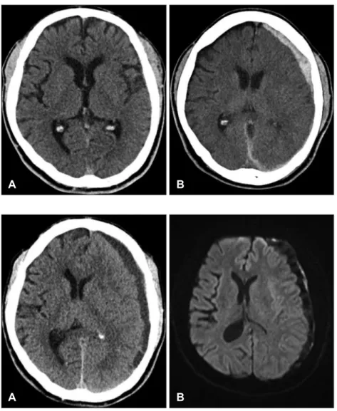 FIGURE 2. (A) Computed tomography  scan disclose increasing mass effect of  hematoma and midline shift of  approxi-mately 10 mm