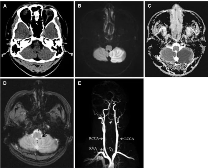 FIGURE 1. (A) Radiologic images at admission. Initial brain computed tomography does not show the abnormal density in the cer- cer-ebellum