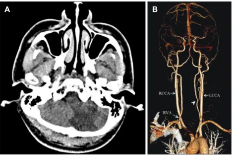 FIGURE 4. Computed tomography (CT)  and CT angiography after 3 months. (A)  Brain CT shows the low density in left  posterior cerebellar artery territory
