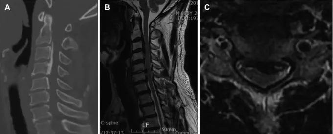 FIGURE 1. (A) Computed tomography scan and (B, C) magnetic resonance imaging reveal cord compression by ossification of the  posterior longitudinal ligament (OPLL) from C2 to C6 with a mixed type (non-fused segment on C4-5)