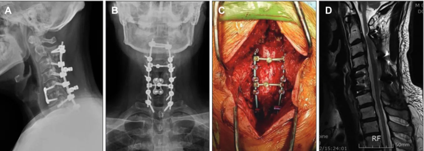 FIGURE 4. (A-C) Additional decompressive laminectomy was performed on the C6 and C7 levels with excoriation of adherent tis- tis-sue around the previous laminectomy site, and then posterior screw fixation was done from C2 to T1 by placing a dome-shaped  cr
