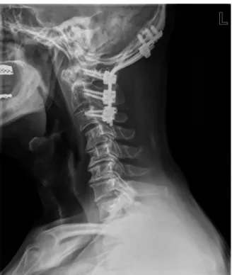 FIGURE 2. Three dimension reconstruction of vertebral artery  computed tomography angiography show occlusion (arrow) at  the C2 transverse process level.