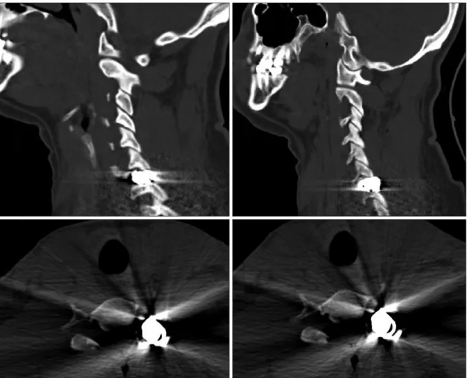 FIGURE 1. Sagital and axial computed tomography images cross-sectionning the bullet.
