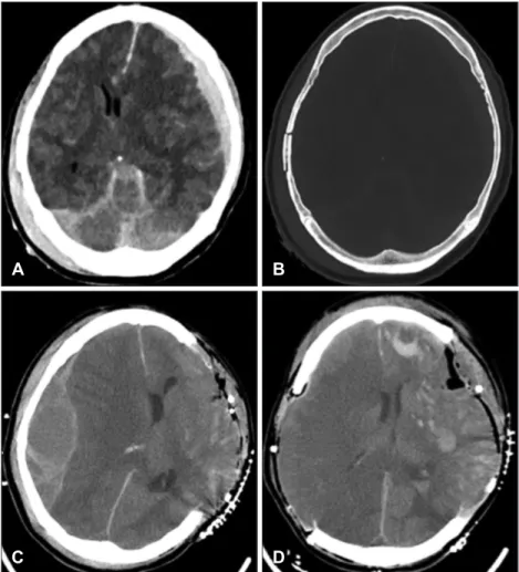 Clinical Features and Outcomes of Bilateral Decompression Surgery for ...