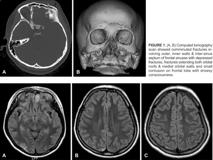 FIGURE 1. (A, B) Computed tomography  scan showed comminuted fractures  in-volving outer, inner walls &amp; inter-sinus  septum of frontal sinuses with depressed  fractures, fractures extending both orbital  roofs &amp; medial orbital walls and small  cont