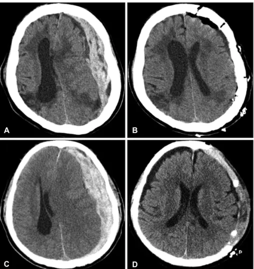 FIGURE 1. Preoperative (A) and  postoperative (B) computed  to-mography (CT) scan of  75-year-old female with acute subdural  hematomas (ASDH) after  trau-matic brain injury