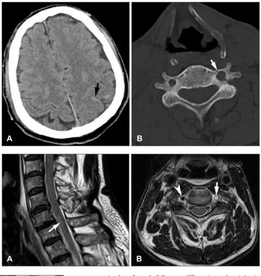 FIGURE 1. A: Brain computed  tomography (CT) scan showing  traumatic subarachnoid  hemor-rhage (arrow) on the left parietal  lobe after trauma