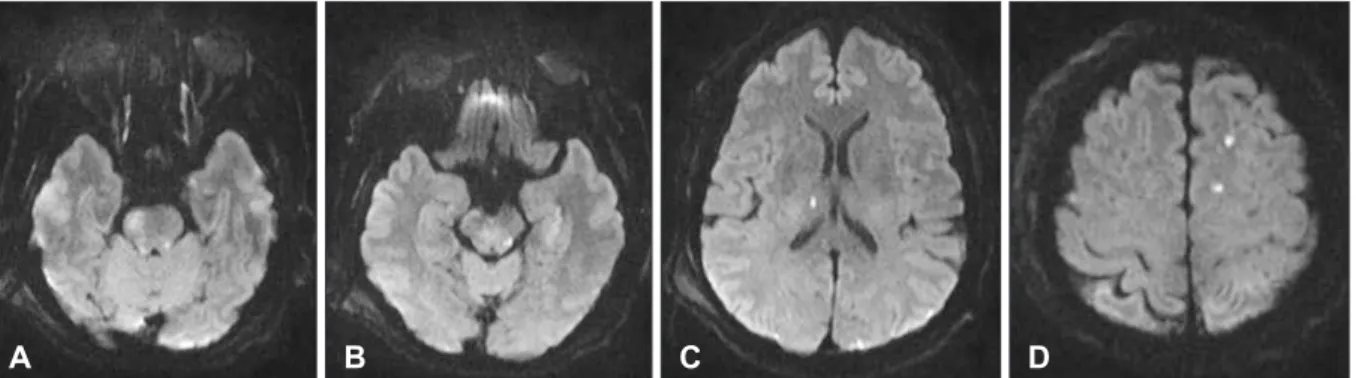 FIGURE 5. Brain computed tomography scan showing chronic  subdural hematomas on both frontal lobes (*) 4 months after  the trauma.
